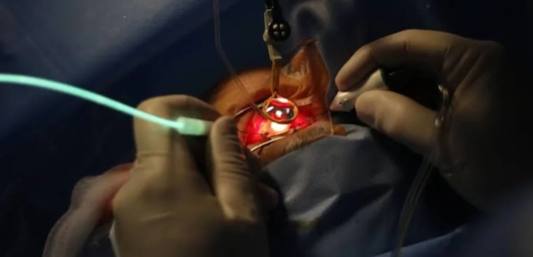 Vitrectomy excellence